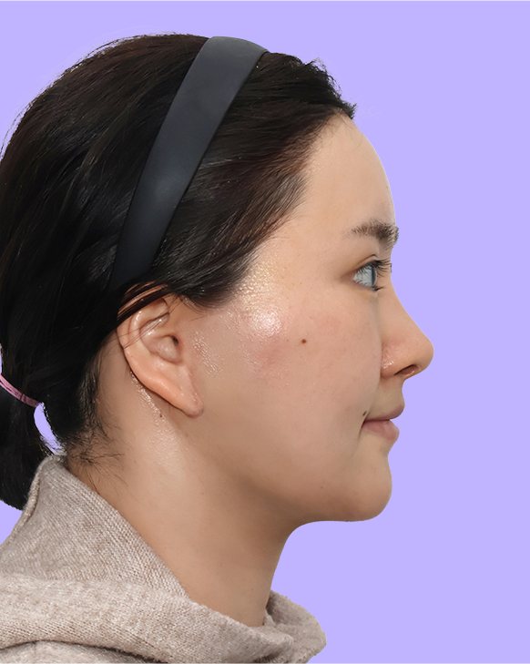 수술 후 측면