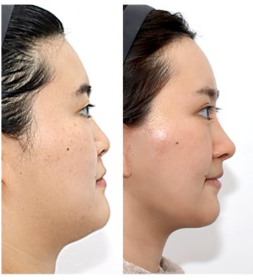 측면 Before & After 나란히