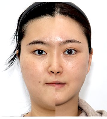정면 반쪽 비교 Before & After