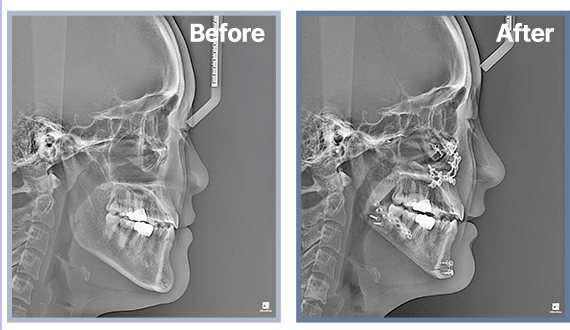 측면 X-ray Before / After(양악수술)