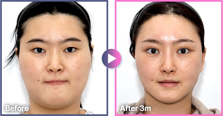 정면 Before / After 3m