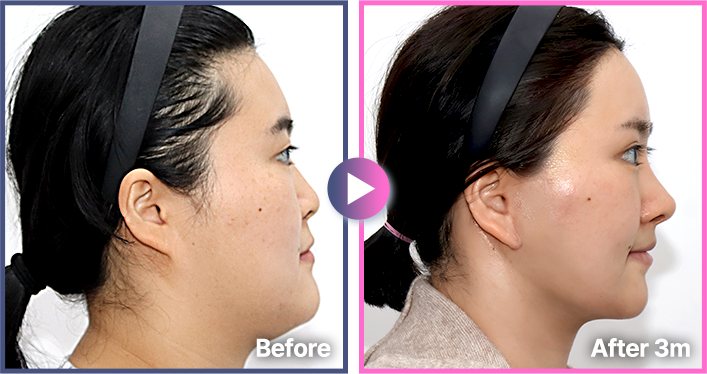 측면 Before / After 3m