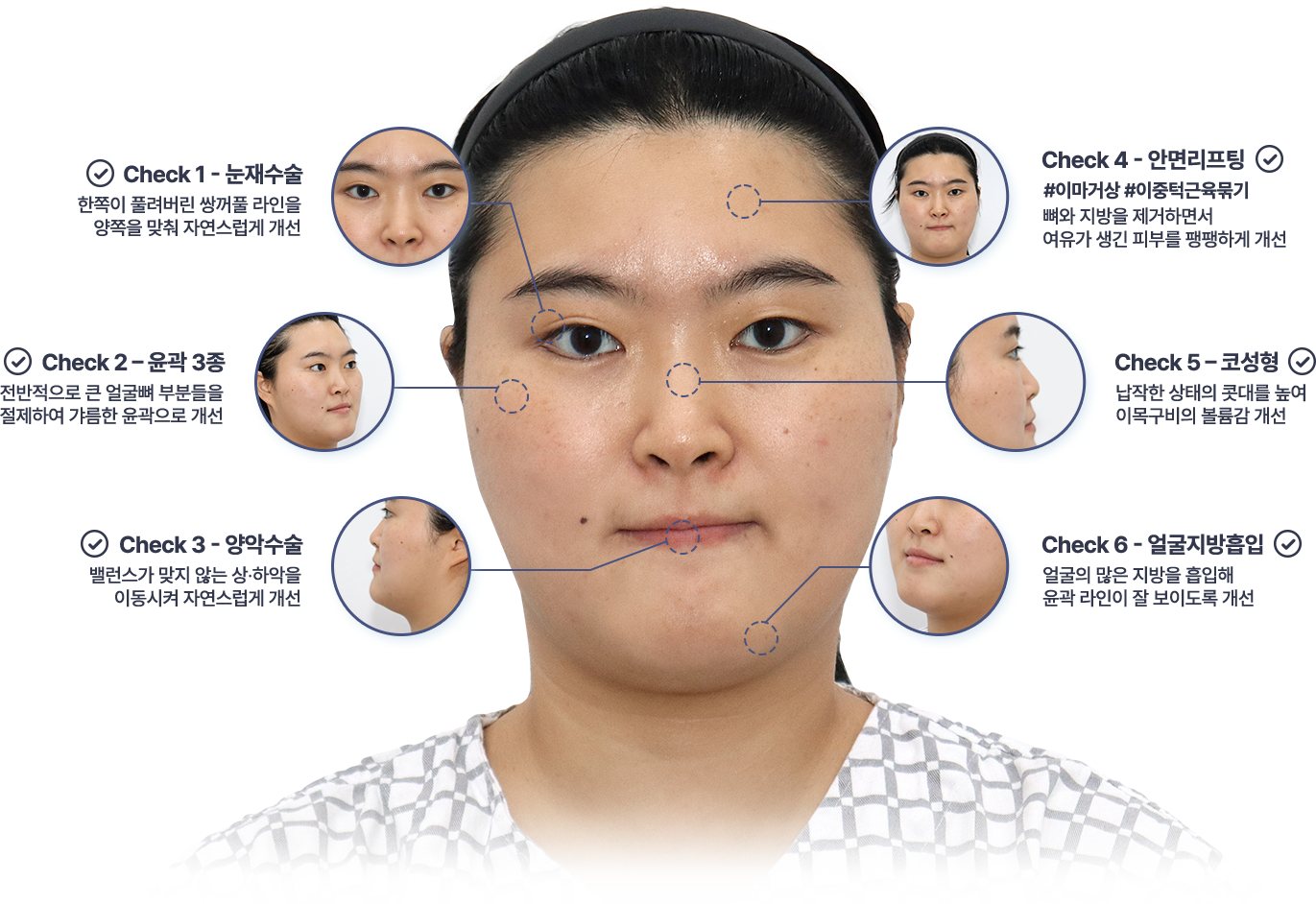 1% MAKE Point - 수술 전 정면 사진 위 Check 1~6 부위 표시(눈재수술·윤곽 3종·양악수술·안면리프팅·코성형·얼굴지방흡입)
