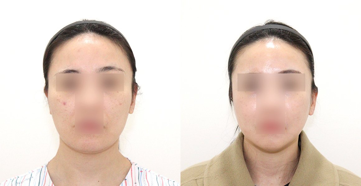전후사진 12 정면(왼쪽 수술 전·오른쪽 수술 후)