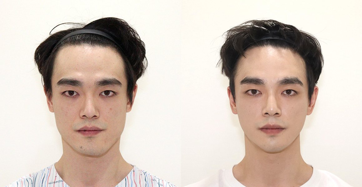 전후사진 6 정면(왼쪽 수술 전·오른쪽 수술 후)