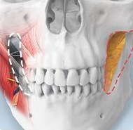 교근·심부볼 축소 부위 도식