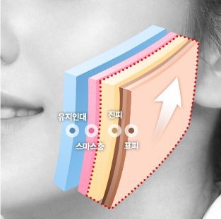 일반 리프팅 — 표피·진피층만 당기는 단면