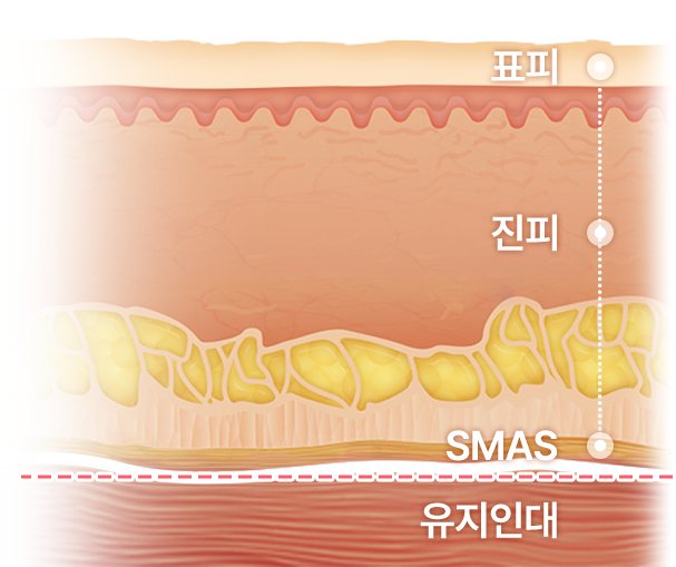 표피·진피·SMAS 3중 고정과 유지인대 컷팅 단면도
