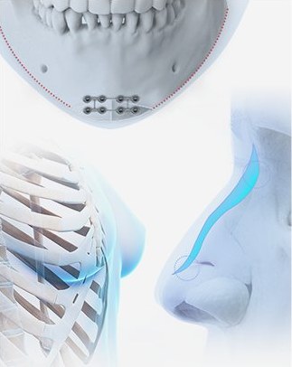 턱뼈 고정 플레이트와 코 보형물·늑연골 3D 이미지