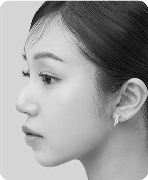 매부리코 + 돌출입 예시 옆모습(흑백)