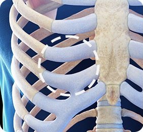 흉곽에서 채취할 늑연골 부분을 점선 원으로 표시한 일러스트