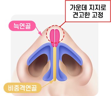 늑연골로 가운데를 지지해 견고하게 고정하는 코 단면 도식(늑연골·비중격연골·가운데 지지로 견고한 고정)