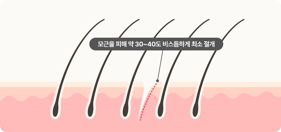 모근 사이 사선 절개 도식 — '모근을 피해 약 30~40도 비스듬하게 최소 절개'
