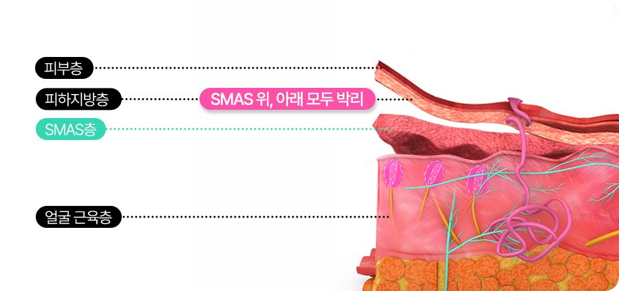 피부 단면 도식 — 피부층·피하지방층·SMAS층·얼굴 근육층, 'SMAS 위, 아래 모두 박리'