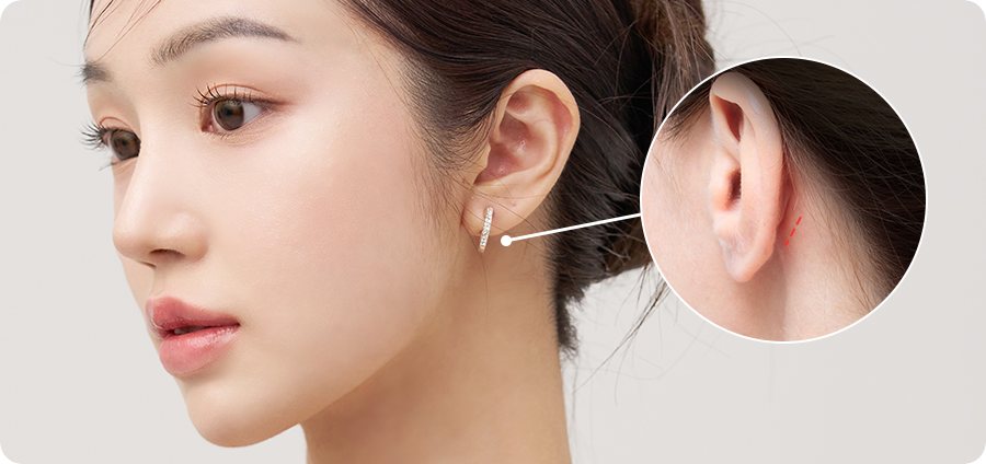 여성 모델 옆얼굴과 귀 뒤 절개선(붉은 선) 확대 원