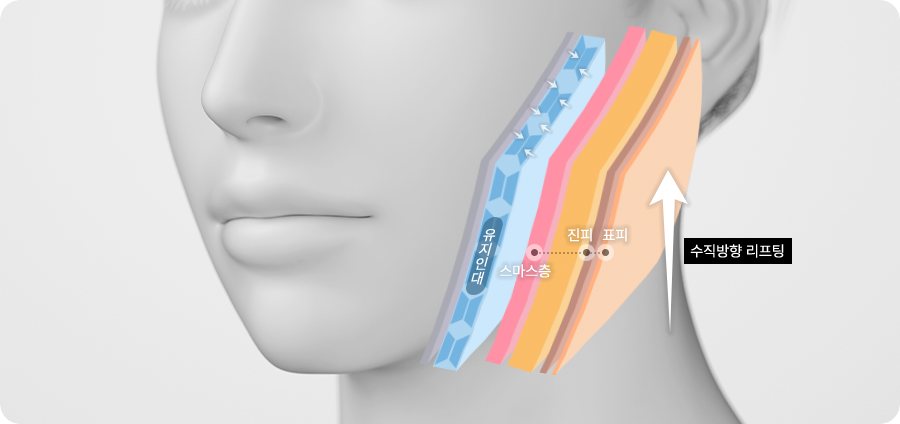 얼굴 층 구조 도식 — 유지인대·스마스층·진피·표피, 수직방향 리프팅 화살표
