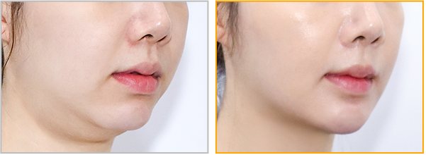 펠리컨성형 사례1 비스듬한 각도 Before / After 3m