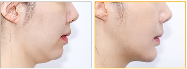 펠리컨성형 사례1 측면 Before / After 3m
