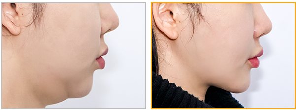 펠리컨성형 사례2 측면 Before / After 3m
