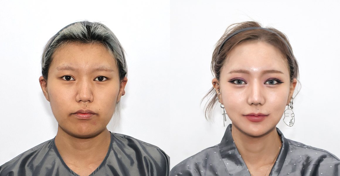전후사진(정면, 왼쪽 수술 전·오른쪽 수술 후) — 양악수술, High-3D 광대, 비스포크 V라인, 1% 안면윤곽수술의 특별함, 턱 끝 근육 묶기