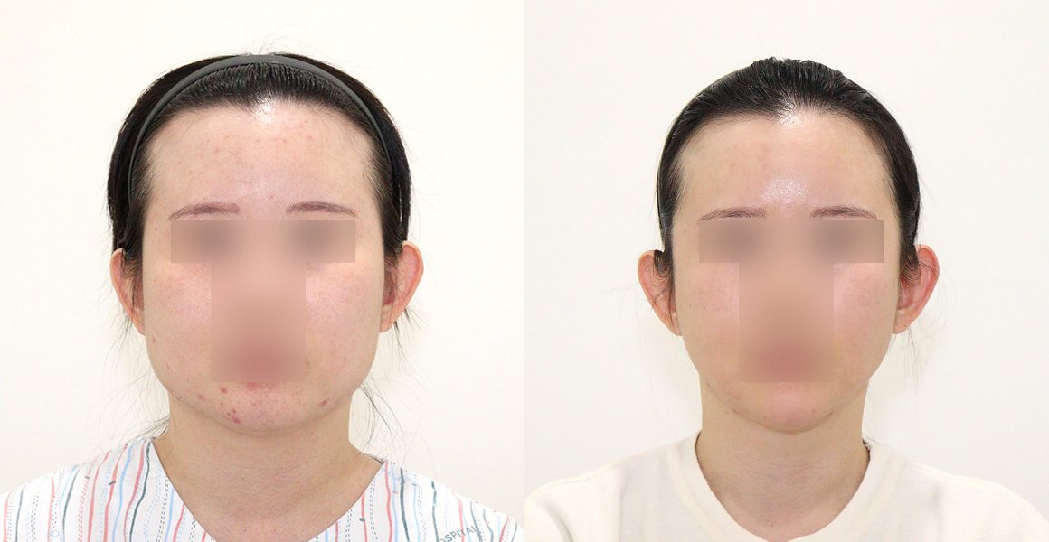 전후사진 3 정면(왼쪽 수술 전·오른쪽 수술 후) — 비스포크 V라인, 애플존 광대, 핸드메이드 지방흡입