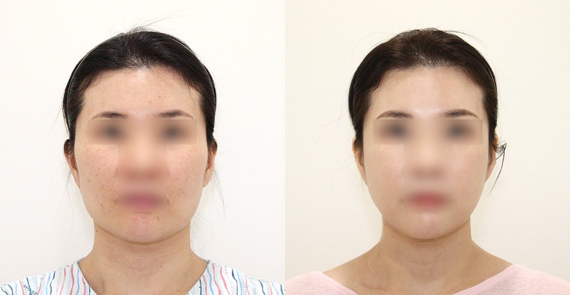 전후사진 5 정면(왼쪽 수술 전·오른쪽 수술 후) — 올포원 사각턱, 애플존 광대