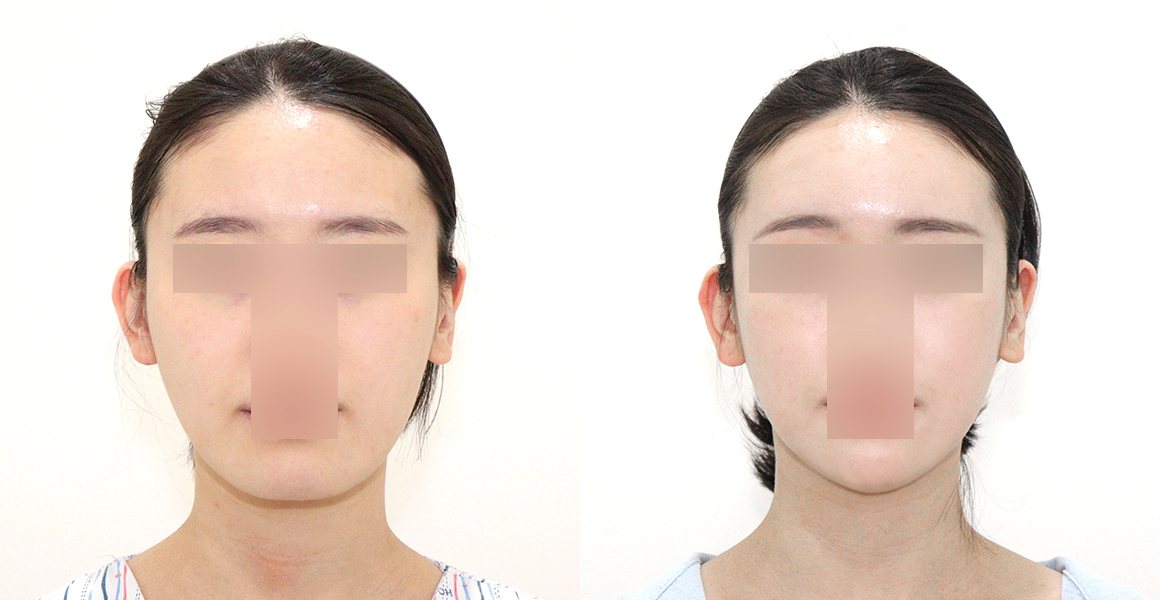전후사진 7 정면(왼쪽 수술 전·오른쪽 수술 후) — 비스포크 미니V라인, 풀페이스지방이식, 애플존 광대