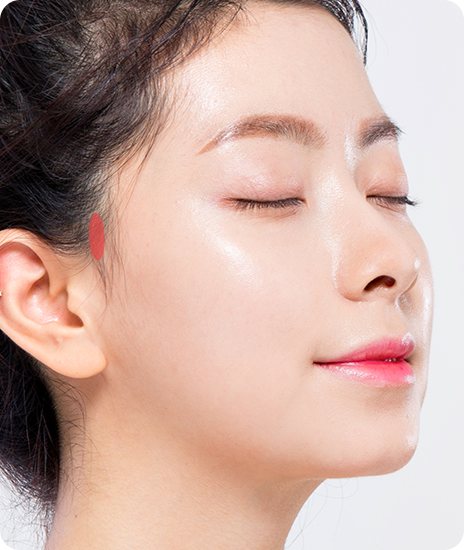 1 구레나룻 부위 최소 절개 — 절개 부위가 표시된 여성 옆얼굴