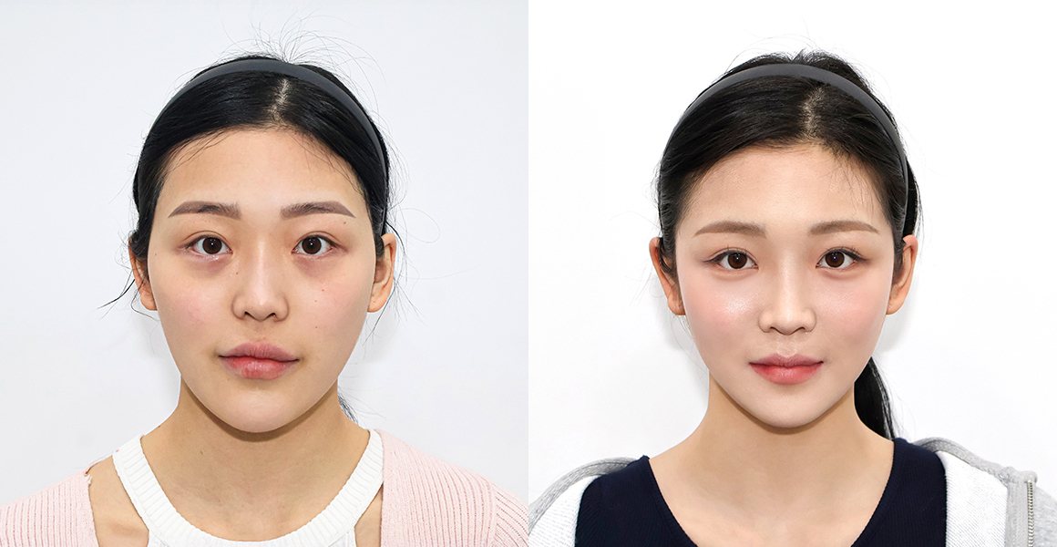 정면 전후 사진 — 양악수술, 비스포크 미니V라인, 1% 안면윤곽수술의 특별함 (수술 후 10개월)