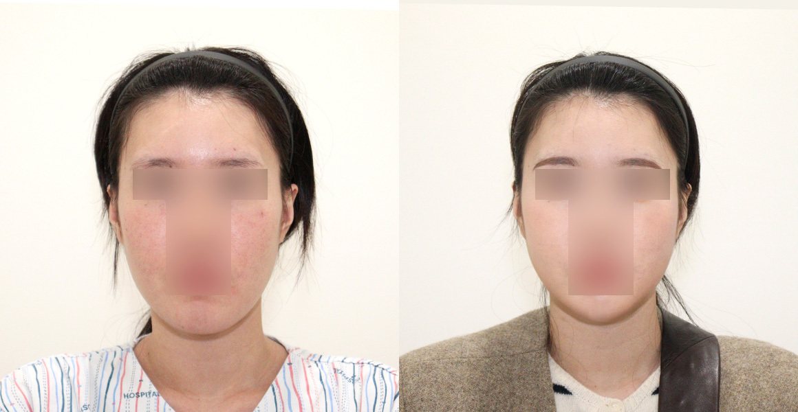 정면 전후 사진 — 1% 안면윤곽수술의 특별함, 비스포크 미니V라인수술, 핸드메이드 지방흡입 (수술후 7개월)