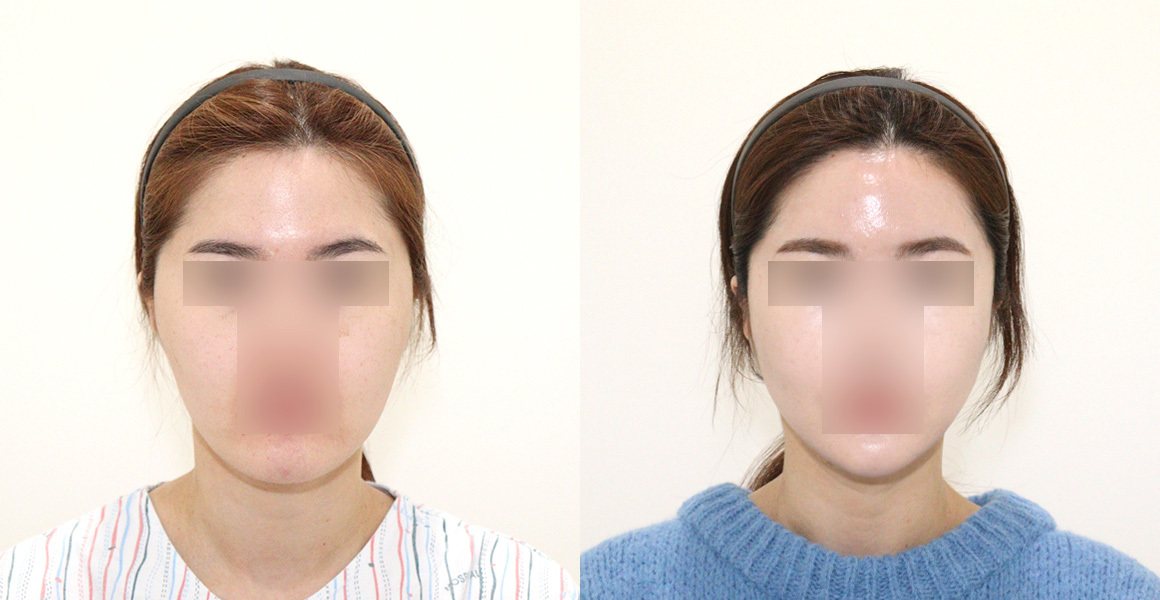 정면 전후 사진 — 비스포크 미니V라인, 풀페이스지방이식, 애플존 광대, 1% 안면윤곽수술의 특별함, 미니멀절개 스마스리프팅 (수술후 6개월)