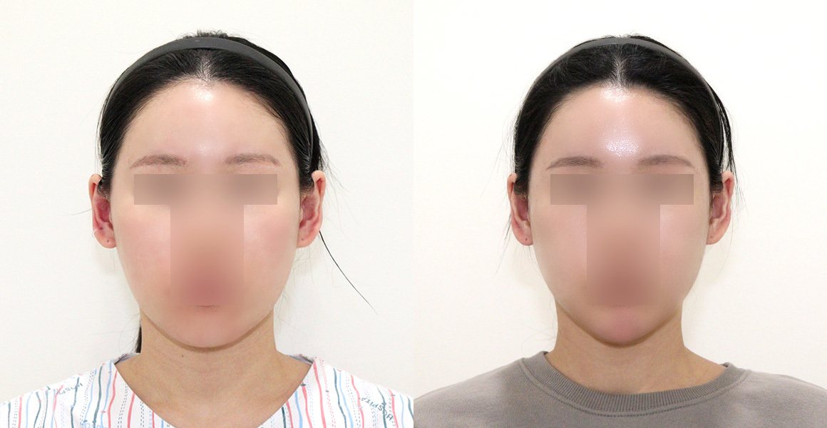 정면 전후 사진 — High-3D 광대, 비스포크 미니V라인, 1% 안면윤곽수술의 특별함, 안면윤곽 재수술 (수술후 5개월)