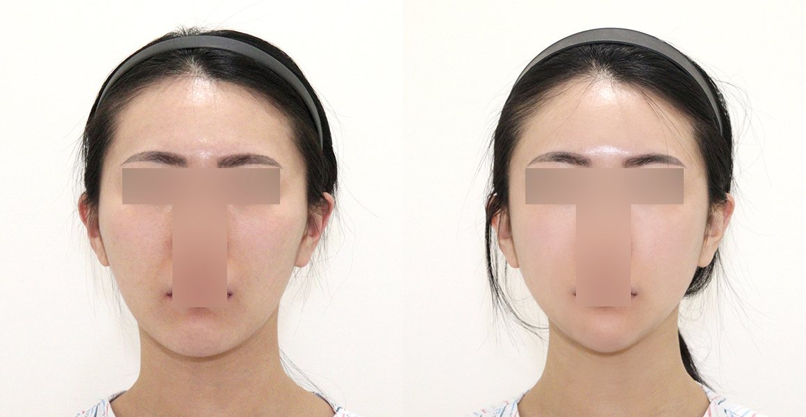 정면 전후 사진 — High-3D 광대, 비스포크 미니V라인, 풀페이스지방이식, 1% 안면윤곽수술의 특별함 (수술후 6개월)