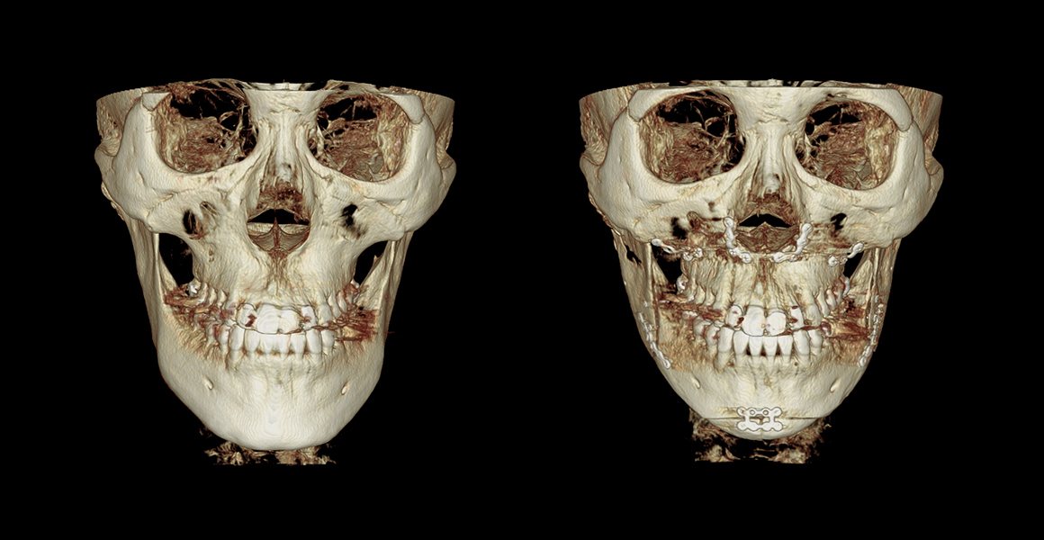정면 3D-CT 전후 사진 — 양악수술, 비스포크 미니V라인수술, 남자 안면윤곽