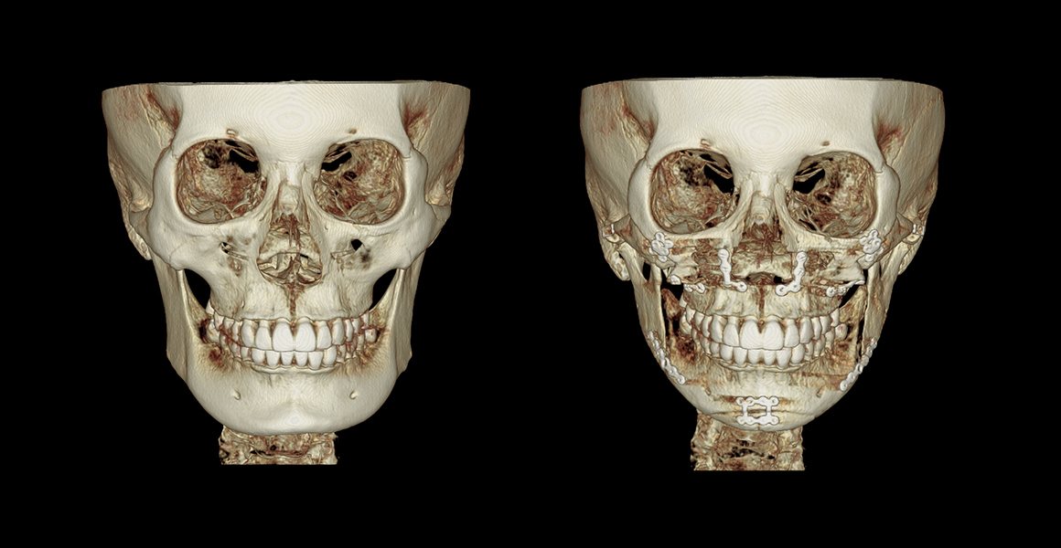 정면 3D-CT 전후 사진 — 양악수술, High-3D광대축소술, 비스포크 미니V라인수술