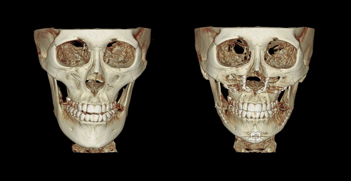 정면 3D-CT 전후 사진 — 양악수술, 비스포크 미니V라인수술