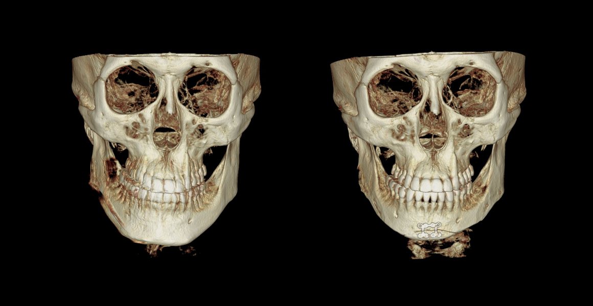 정면 3D-CT 전후 사진 — 비스포크 미니V라인수술, 남자 안면윤곽