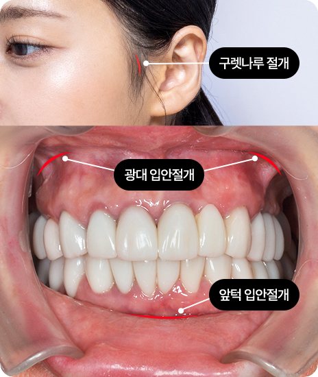 구렛나루 절개·광대 입안절개·앞턱 입안절개 부위 표시 사진