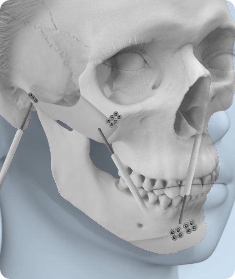 광대·앞턱 고정핀 위치를 표시한 두개골 3D 그림