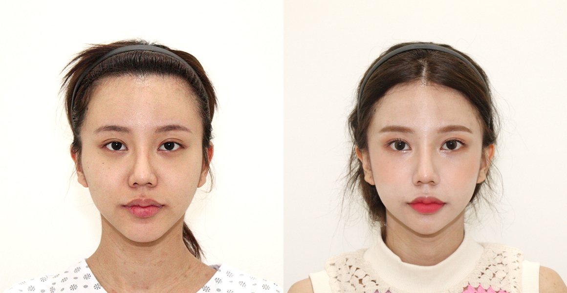 전후사진(정면, 왼쪽 수술 전·오른쪽 수술 후) — High-3D 광대, 비스포크 미니V라인, 1% 안면윤곽수술의 특별함, 핸드메이드 지방흡입