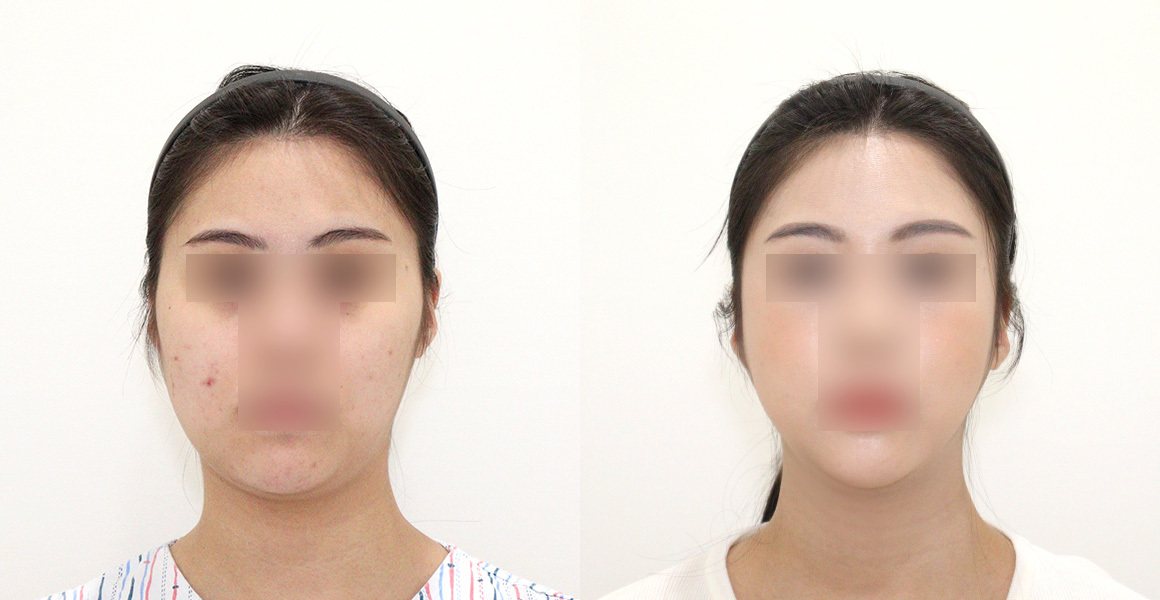 전후사진(정면, 왼쪽 수술 전·오른쪽 수술 후, 얼굴 모자이크) — High-3D 광대, 비스포크 V라인, 1% 안면윤곽수술의 특별함, 핸드메이드 지방흡입