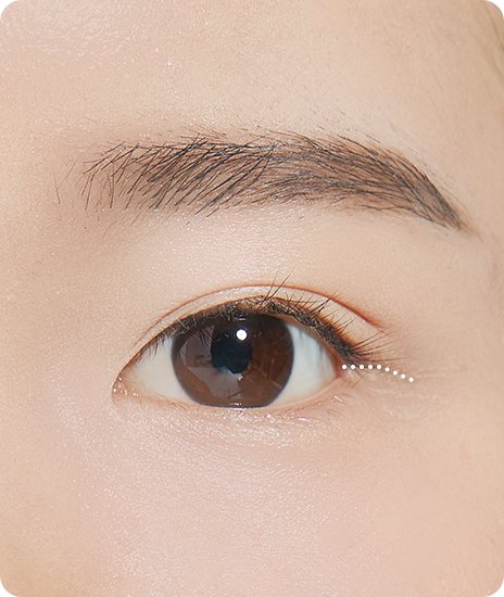 눈꼬리 바깥쪽 절개선(점선) 표시 일러스트