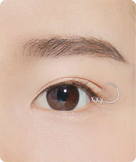눈꼬리 안쪽 봉합(×표) 일러스트