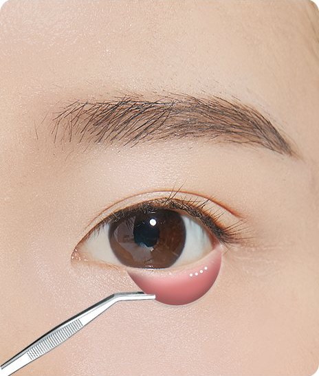 핀셋으로 아래 눈꺼풀을 젖혀 눈 안쪽 결막 뒤쪽을 절개하는 일러스트