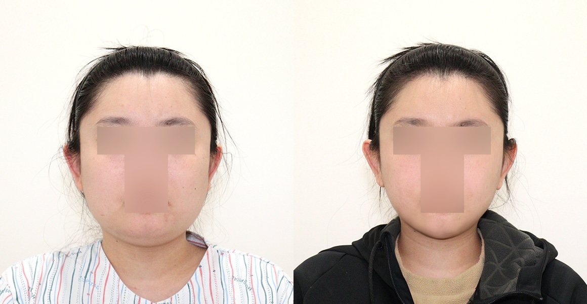 전후사진 11 정면(왼쪽 수술 전·오른쪽 수술 후)
