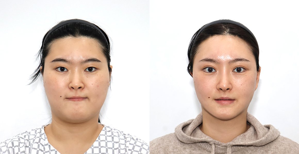 전후사진 6 정면(왼쪽 수술 전·오른쪽 수술 후)