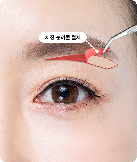 눈썹 아래 붉게 표시된 절제 부위와 핀셋 — '처진 눈꺼풀 절제' 라벨