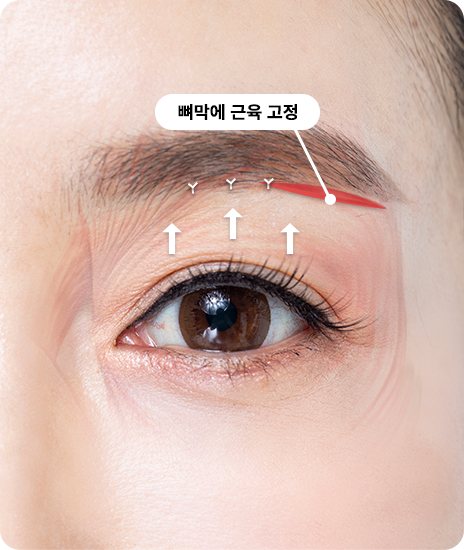 눈꺼풀을 위로 당기는 화살표와 봉합선 — '뼈막에 근육 고정' 라벨