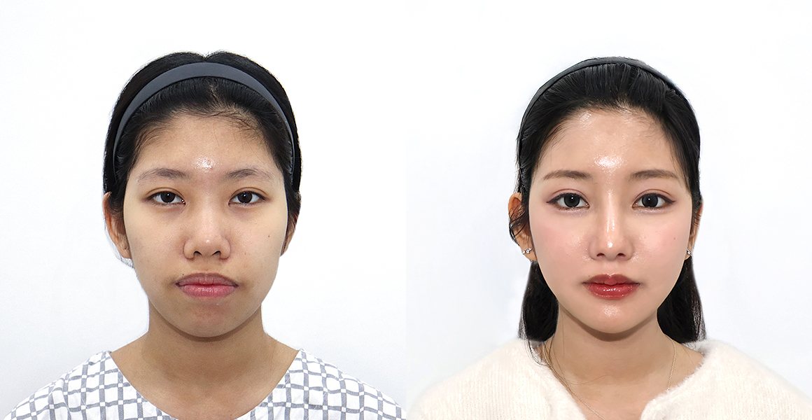 전후사진(정면, 왼쪽 수술 전·오른쪽 수술 후) — 양악수술, High-3D 광대, 비스포크 V라인, 1% 안면윤곽수술의 특별함