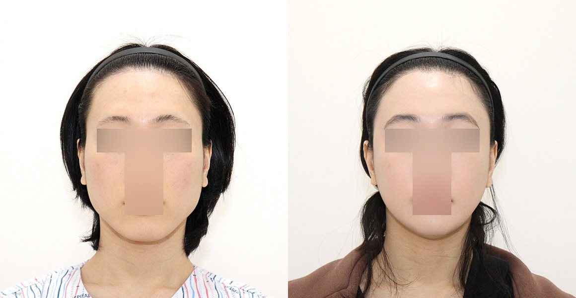 전후사진(정면, 왼쪽 수술 전·오른쪽 수술 후) — High-3D 광대, 비스포크 V라인, 1% 안면윤곽수술의 특별함